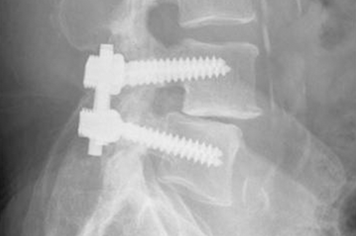 Market Entry 101: European Orthopaedic & Spinal Manufacturing